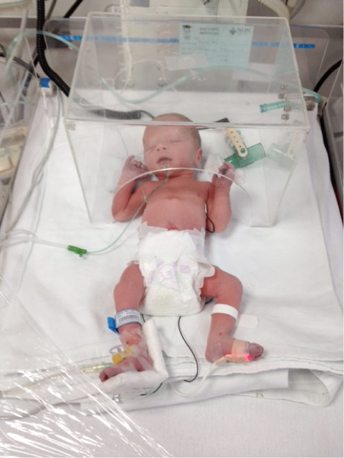 premature baby in incubator with wires and tubes